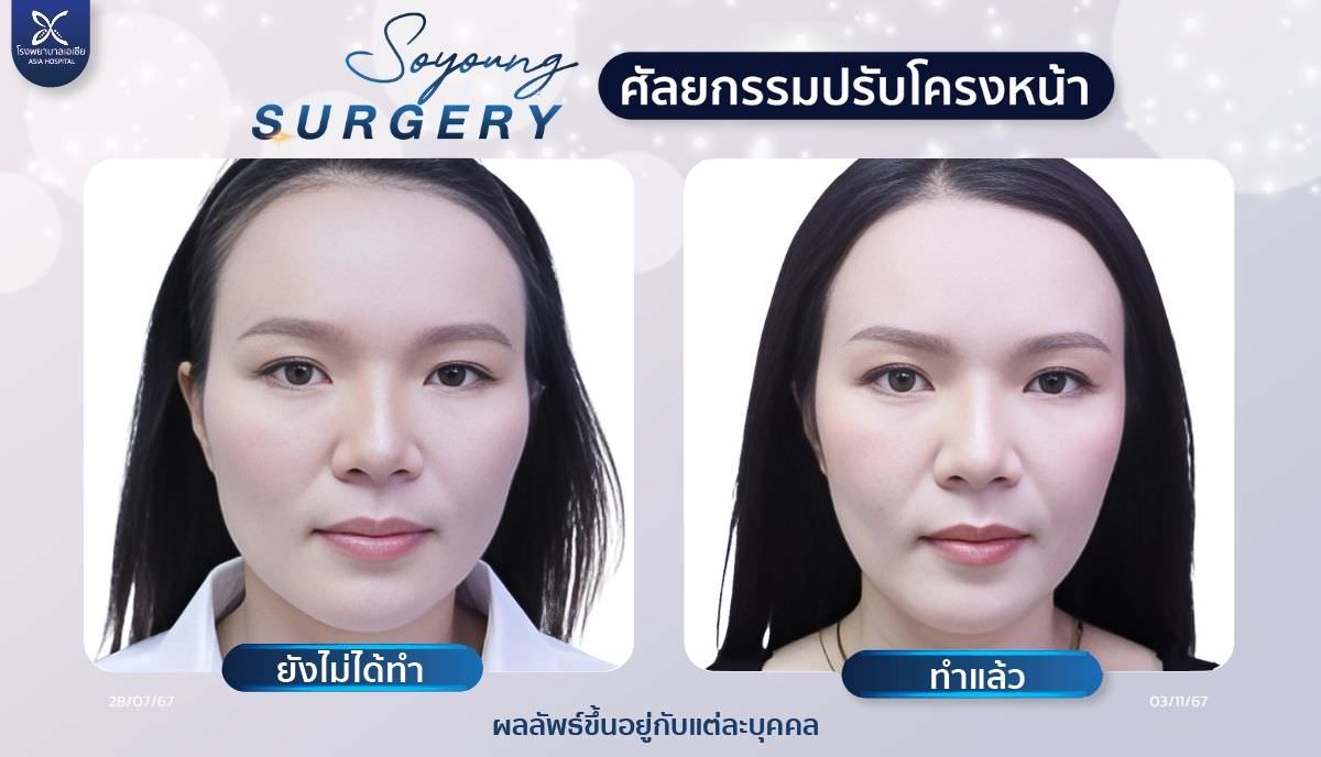 วีไลน์_V-Line_หน้าเรียว_asiacosmetichospital