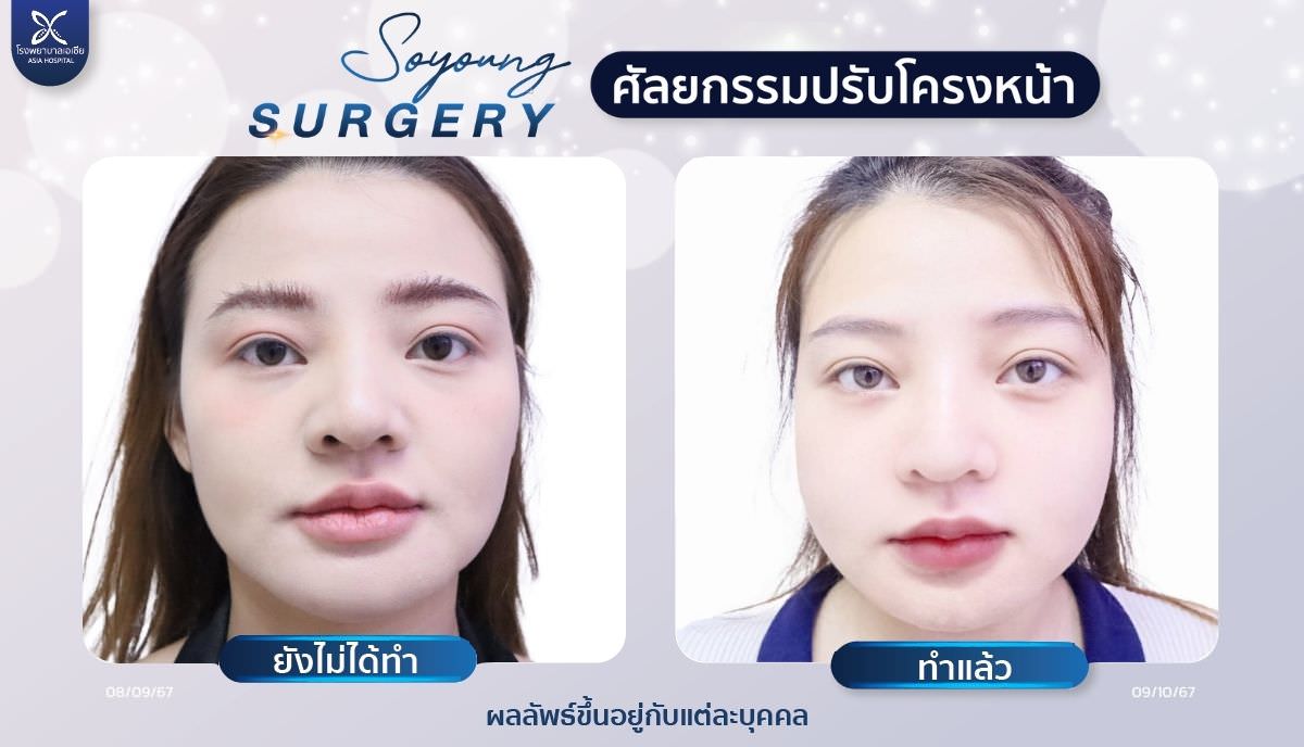 วีไลน์_V-Line_หน้าเรียว_โรงพยาบาลเอเซีย