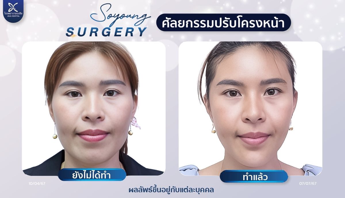 วีไลน์_vline_หน้าเรียว _โรงพยาบาลเอเซีย