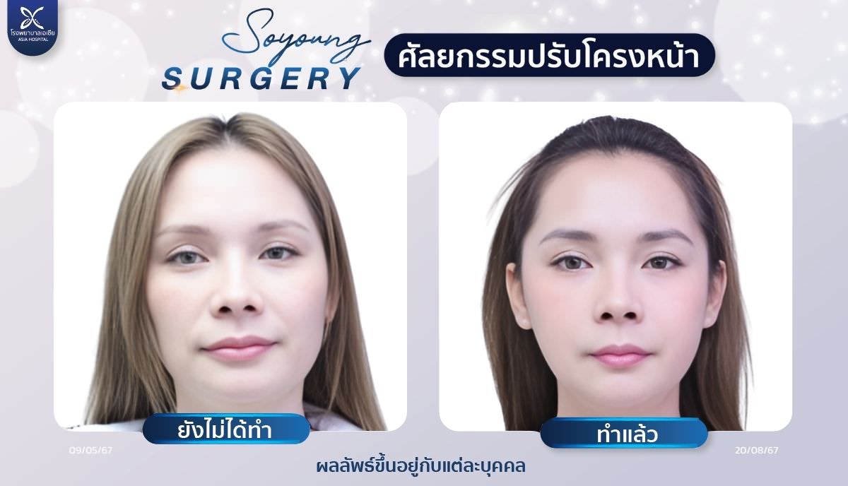 วีไลน์_ปรับโครงหน้า_โรงพยาบาลเอเซีย