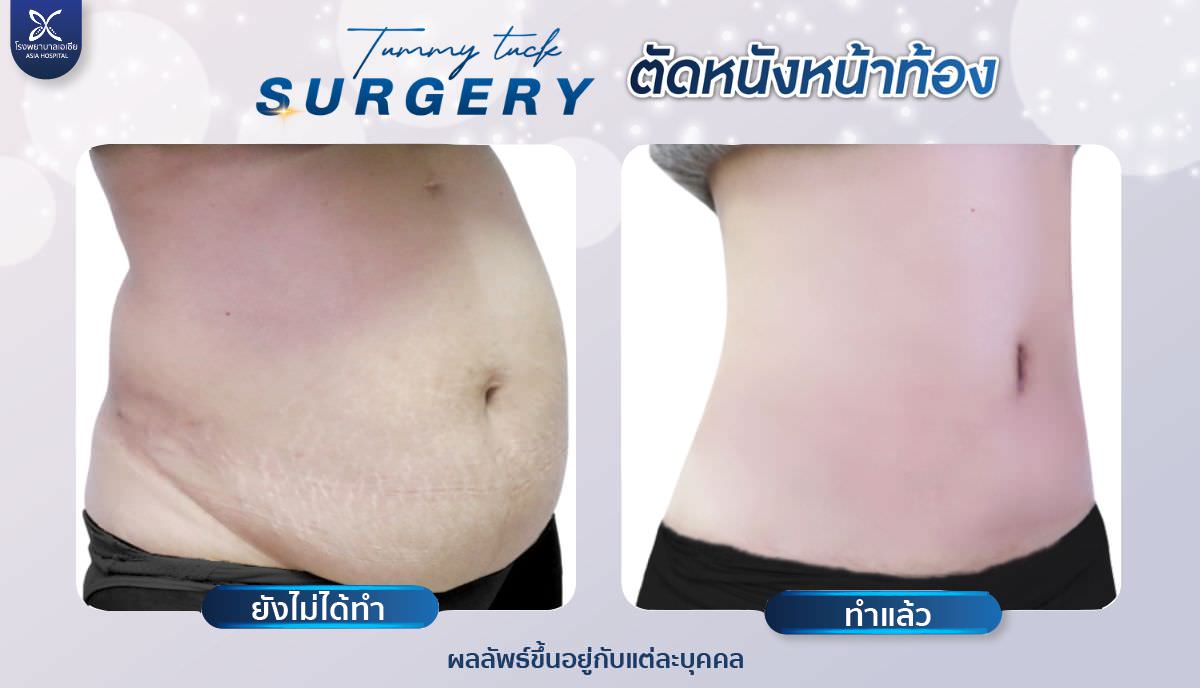 ศัลยกรรม-ตัดหนังหน้าท้อง-TummyTuck