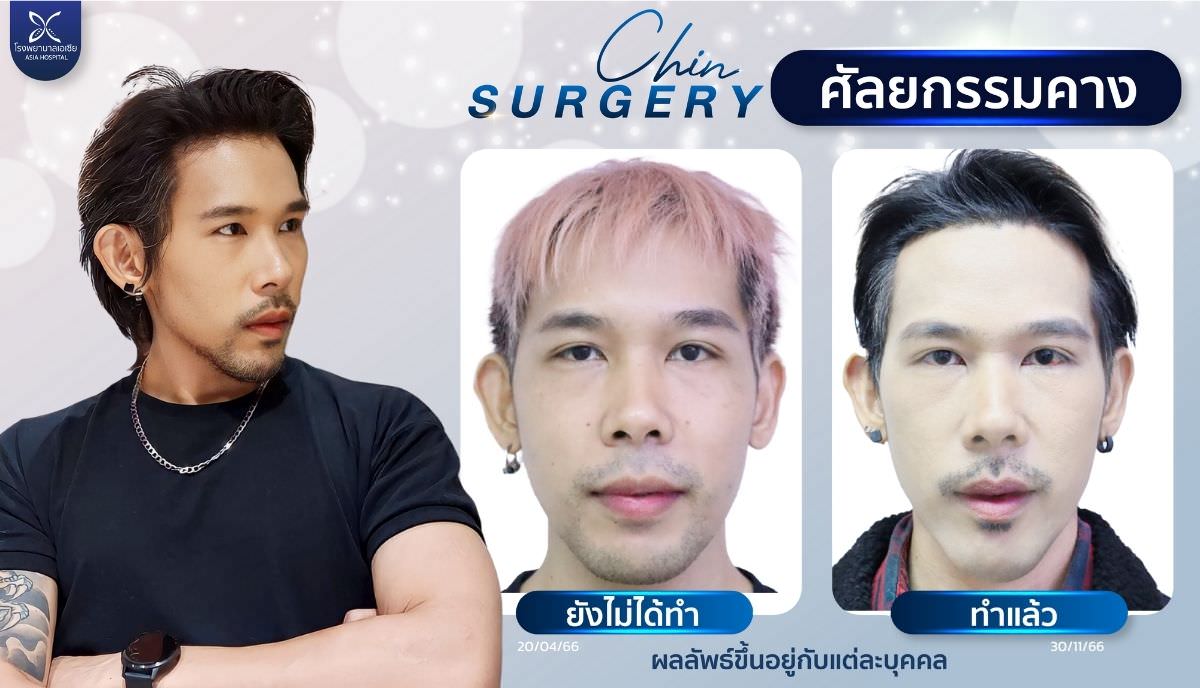 ศัลยกรรมคาง_เสริมคางผู้ชาย