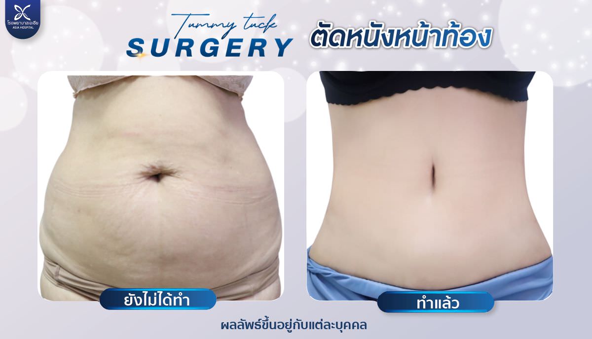 ศัลยกรรมตัดหนังหน้าท้อง-asiahospital