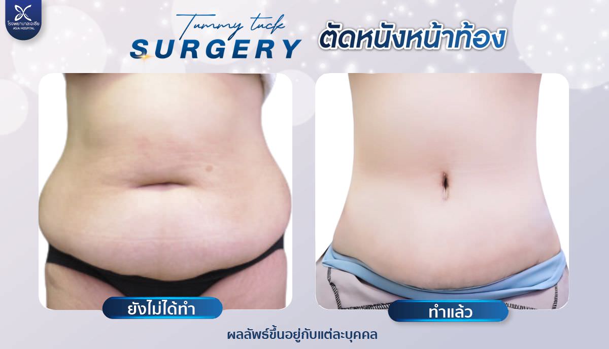 ศัลยกรรมตัดหนังหน้าท้อง-tummytuck