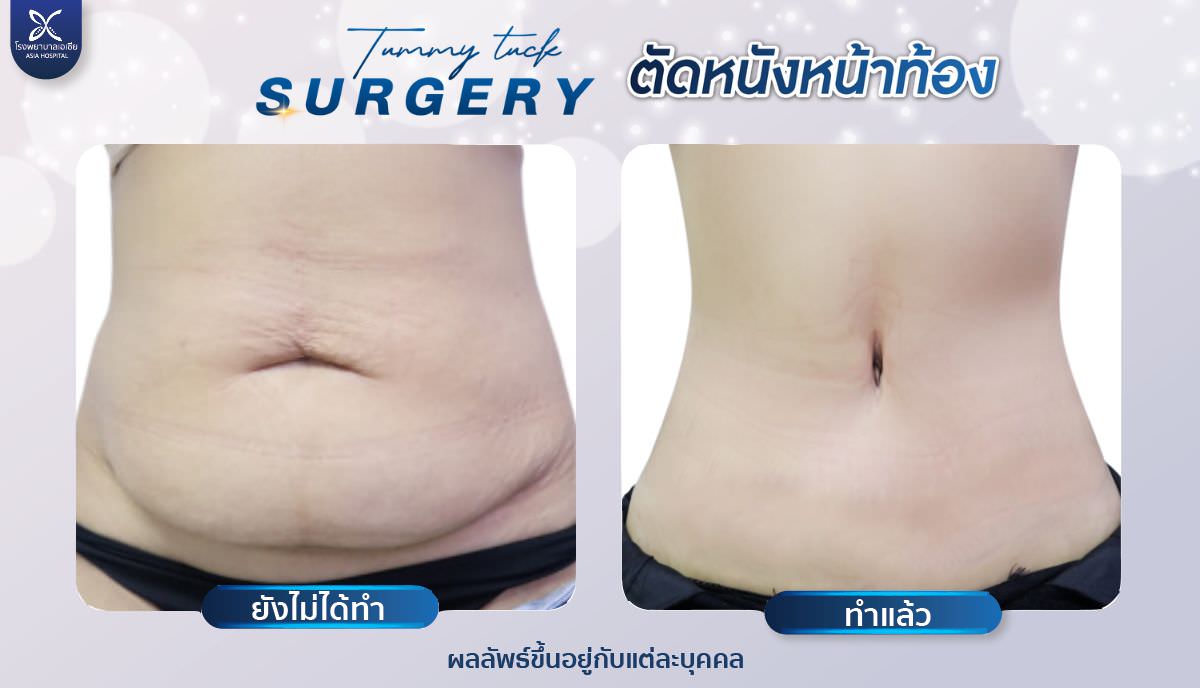ศัลยกรรมตัดหนังหน้าท้อง-ยกกระชับ