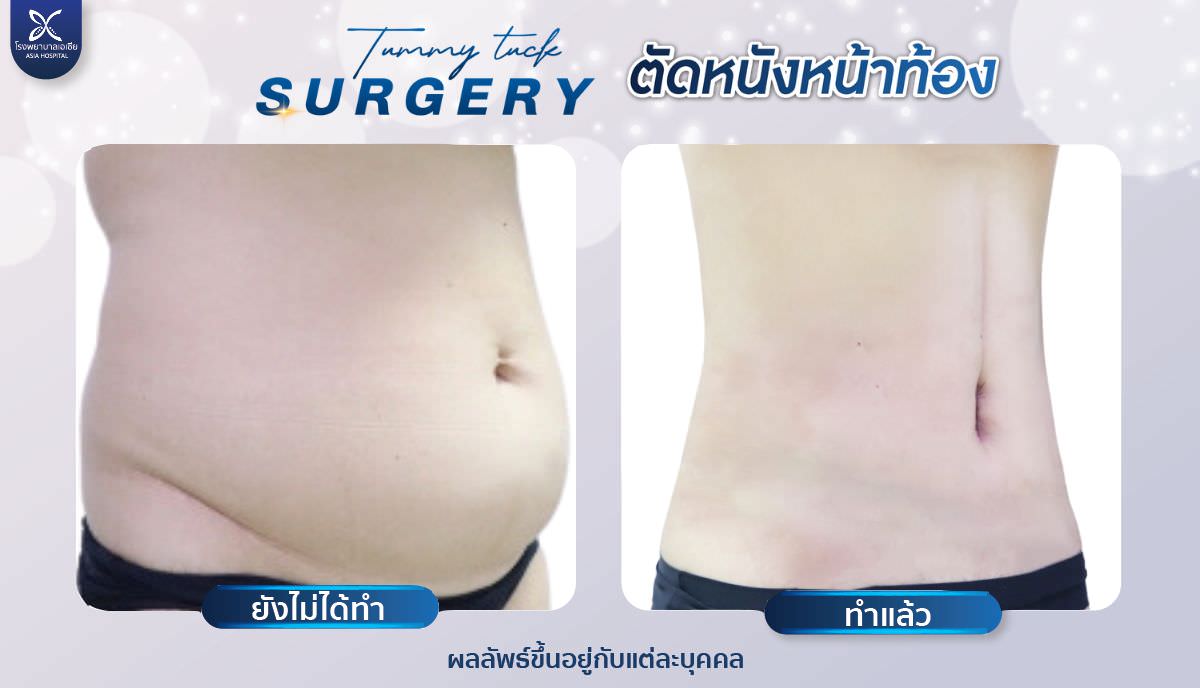 ศัลยกรรมตัดหนังหน้าท้อง-โรงพยาบาลเอเซีย