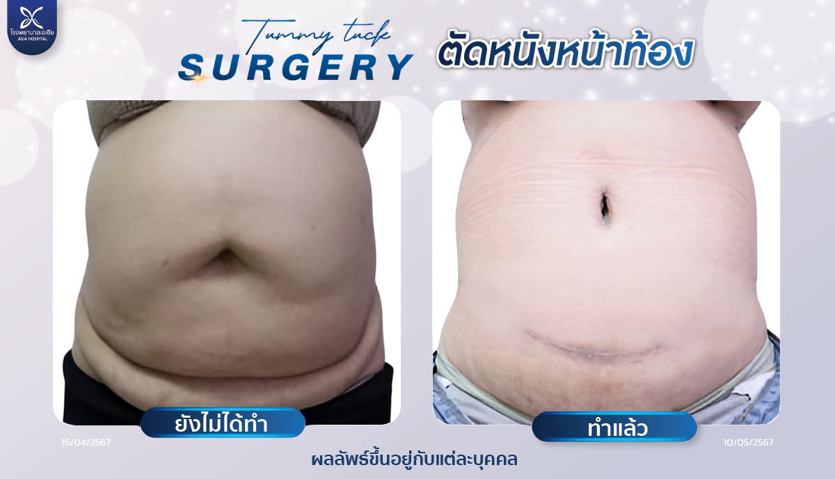 ศัลยกรรมตัดหนังหน้าท้อง