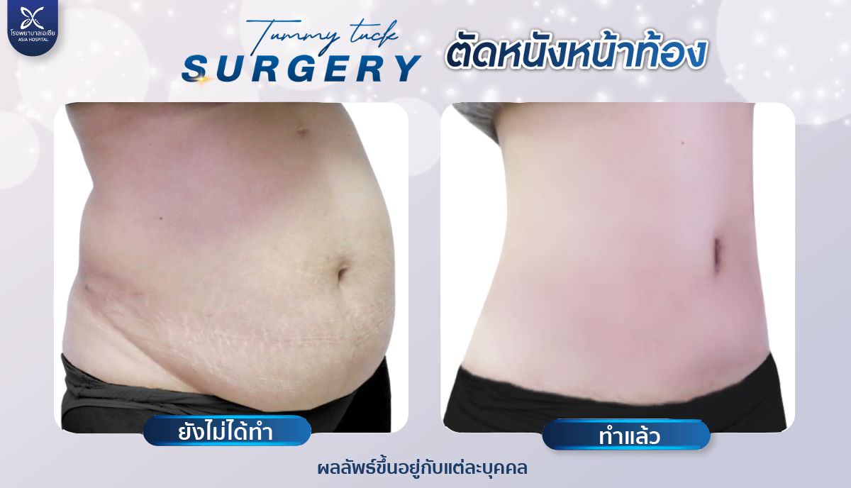 ศัลยกรรมตัดไขมันหน้าท้อง-โรงพยาบาลเอเซีย