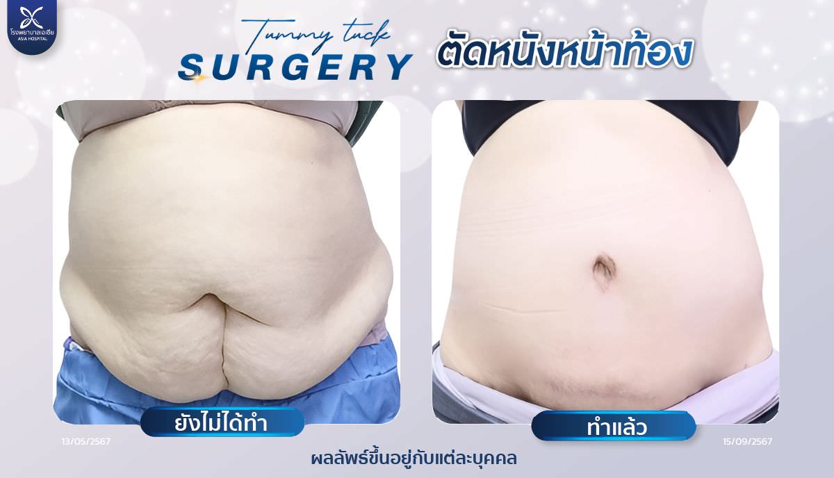ศัลยกรรมตัดไขมันหน้าท้อง