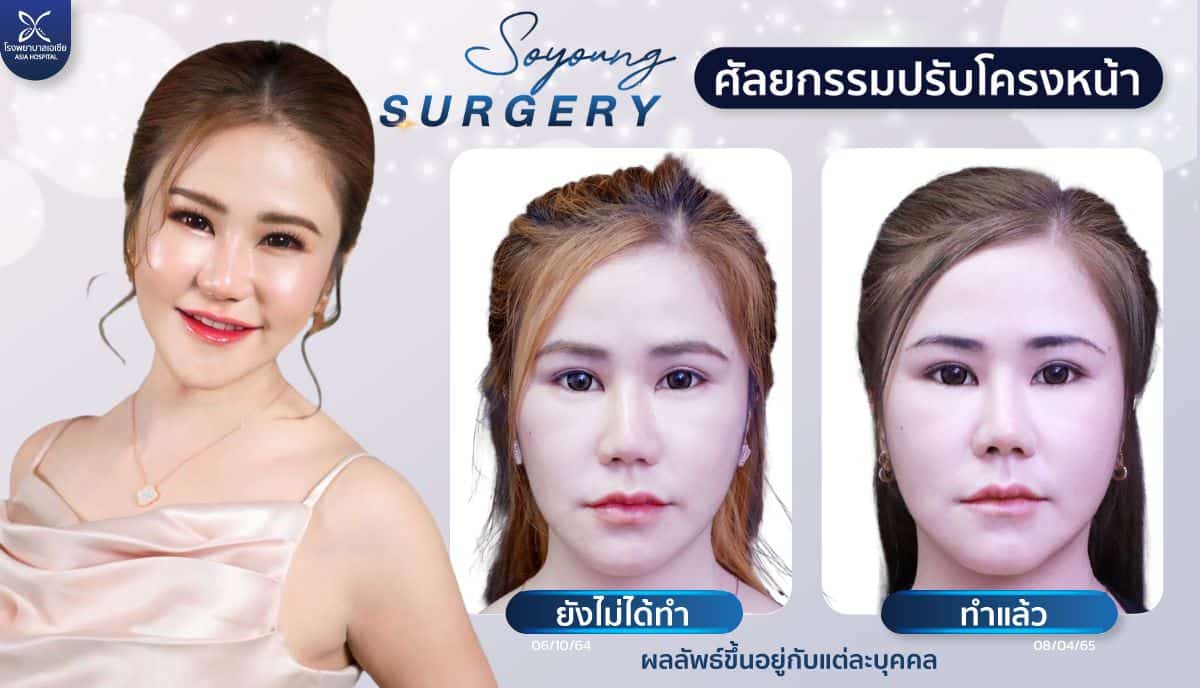 ศัลยกรรมทุบโหนกแก้ม-ยุบโหนกแก้ม-โรงพยาบาลเอเซีย