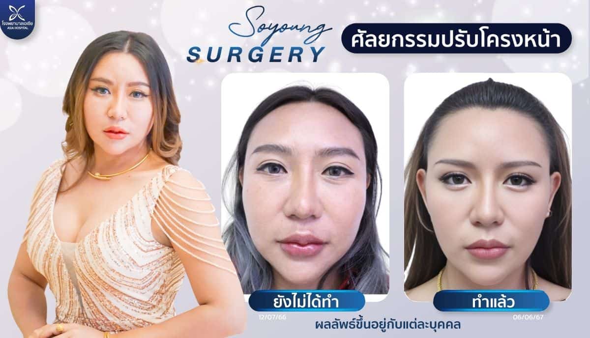 ศัลยกรรมยุบโหนกแก้ม-ทุบโหนกแก้ม-โรงพยาบาลเอเซีย