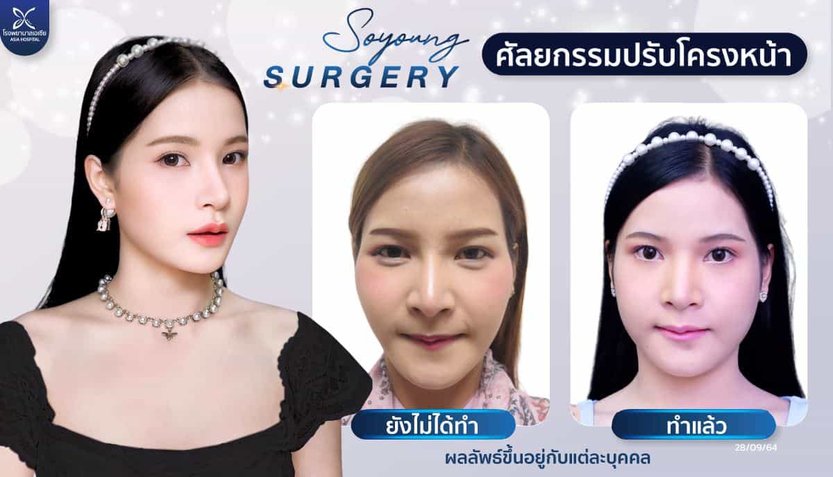 ศัลยกรรมยุบโหนกแก้ม-ลดโหนกแก้ม-โรงพยาบาลเอเซีย