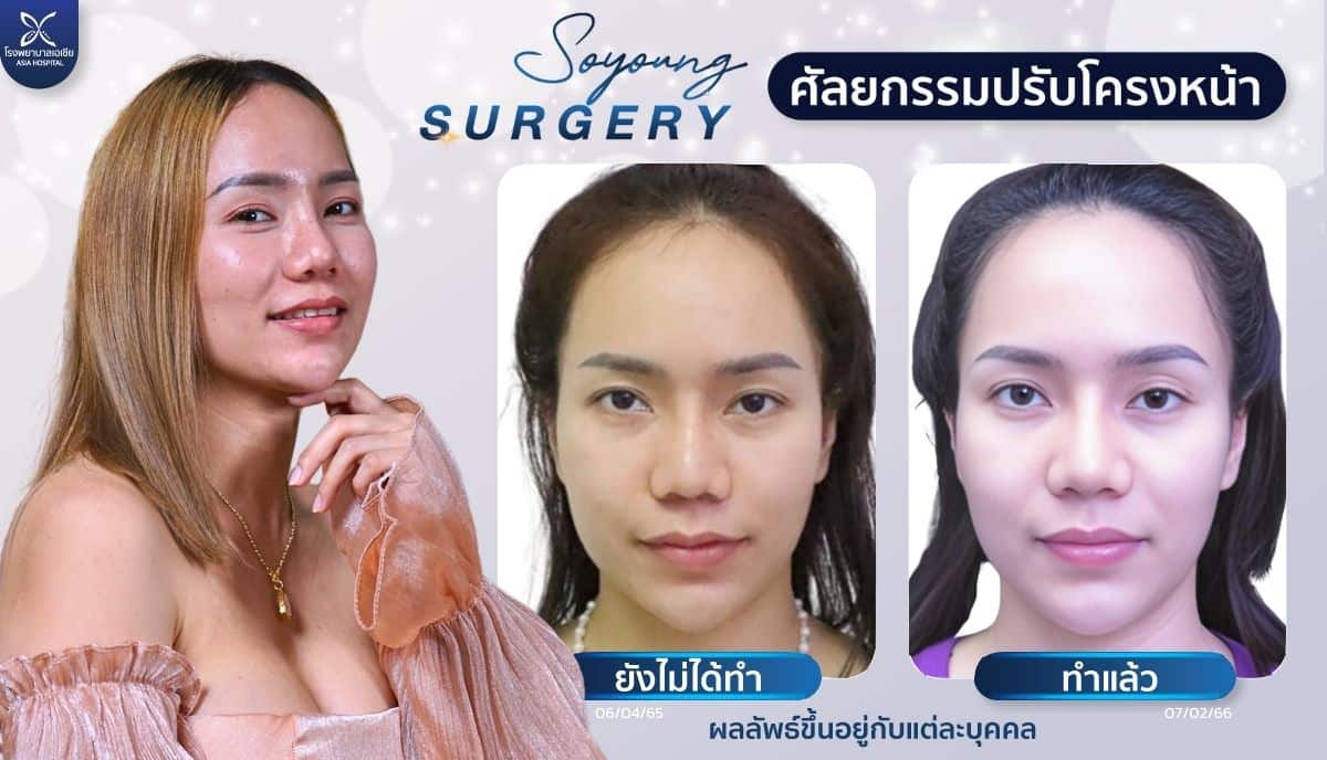 ศัลยกรรมลดโหนกแก้ม-ยุบโหนกแก้ม-โรงพยาบาลเอเซีย