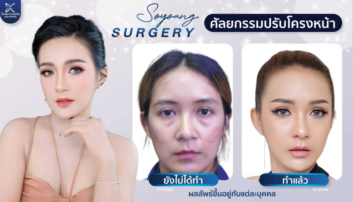 ศัลยกรรมลดโหนกแก้ม-ยุบโหนก-ทุบโหนก-ปรับรูปหน้า