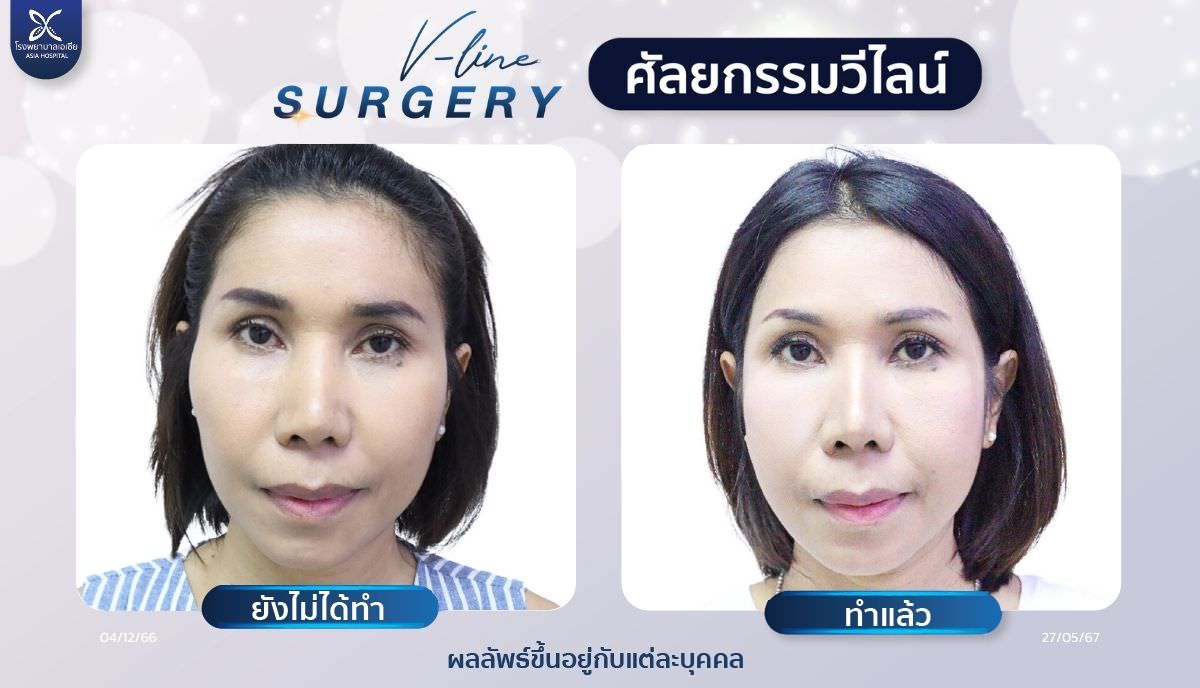 ศัลยกรรมวีไลน์_โรงพยาบาลเอเซีย