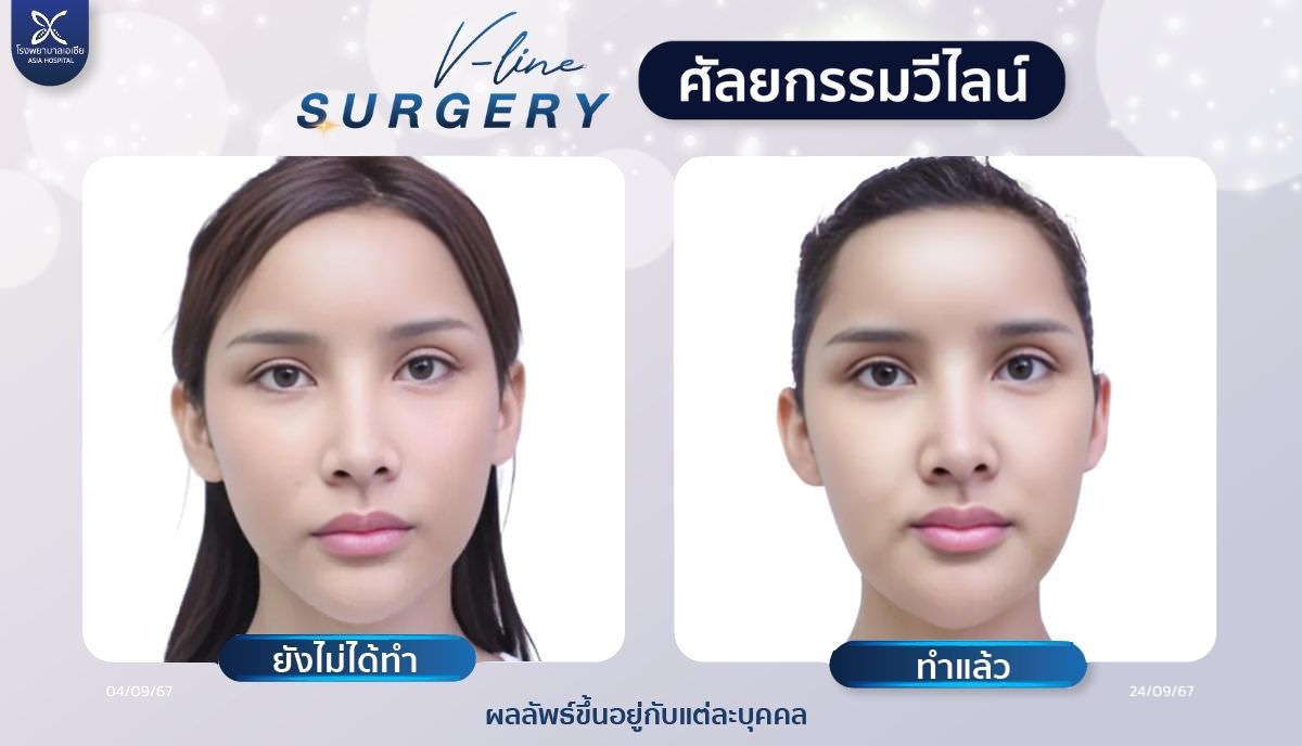 ศัลยกรรมวีไลน์_vline_โรงพยาบาลเอเซีย