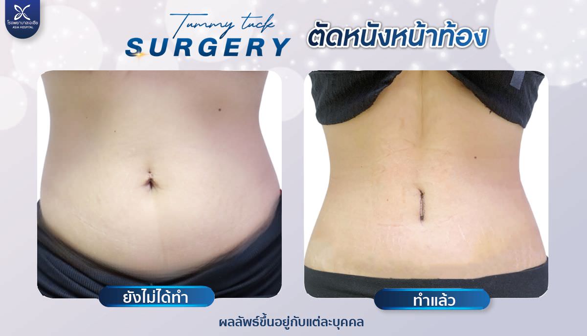 ศัลยกรรมหน้าท้อง-คุณแม่หลังคลอด