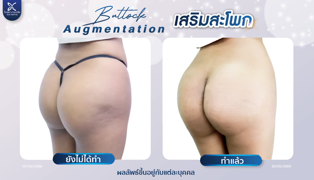 เสริมก้น-เสริมสะโพก-โรงพยาบาลเอเซีย
