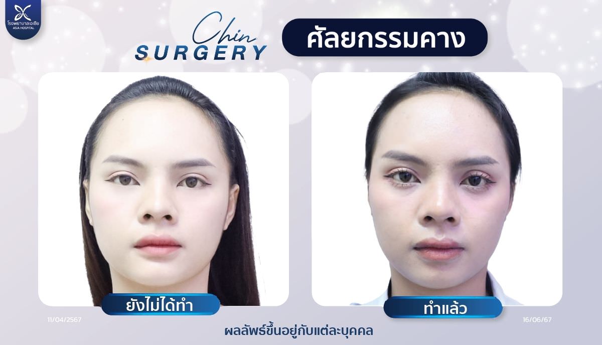 เสริมคาง_ศัลยกรรมคาง_โรงพยาบาลเอเซีย