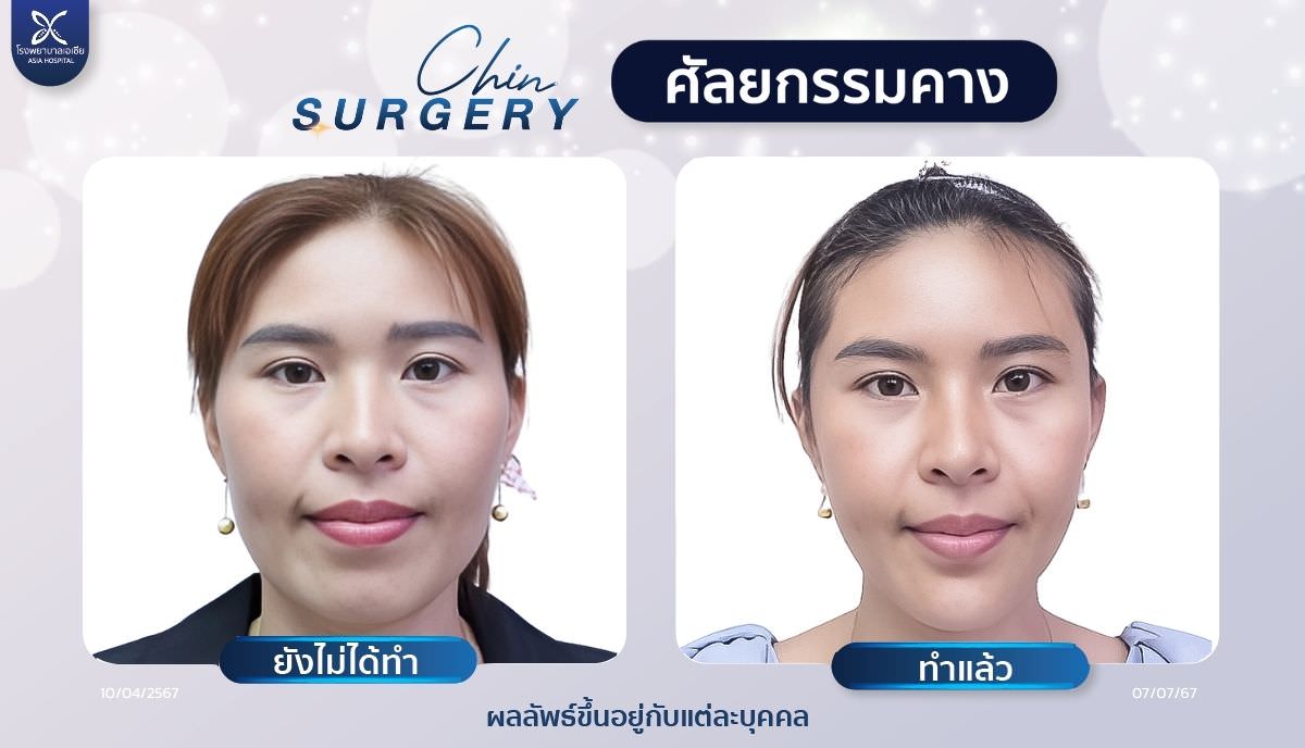 เสริมคาง_โรงพยาบาลเอเซีย