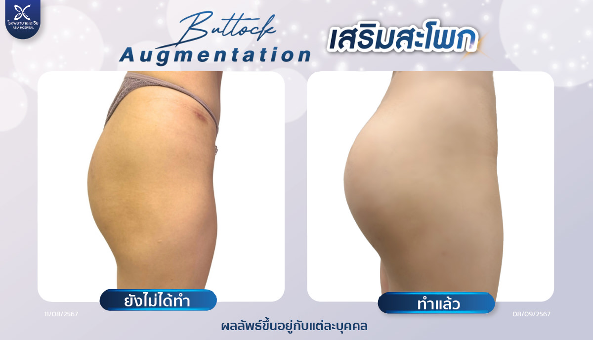 เสริมก้น-เสริมสะโพก-โรงพยาบาลเอเซีย