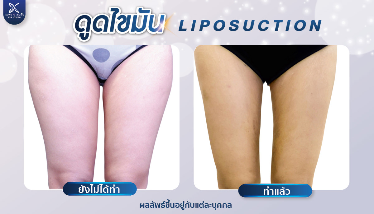 ดูดไขมันต้นขา
