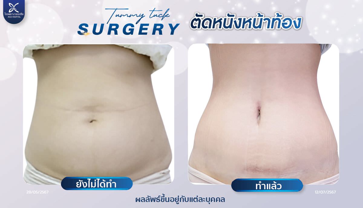 โรงพยาบาลเอเซีย-ตัดหนังหน้าท้อง