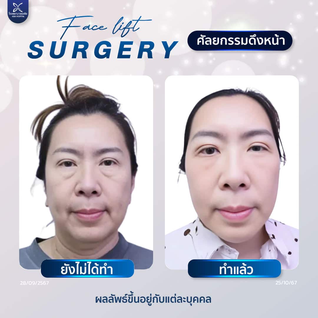 facelift_necklift_ดึงหน้า_ดึงคอ