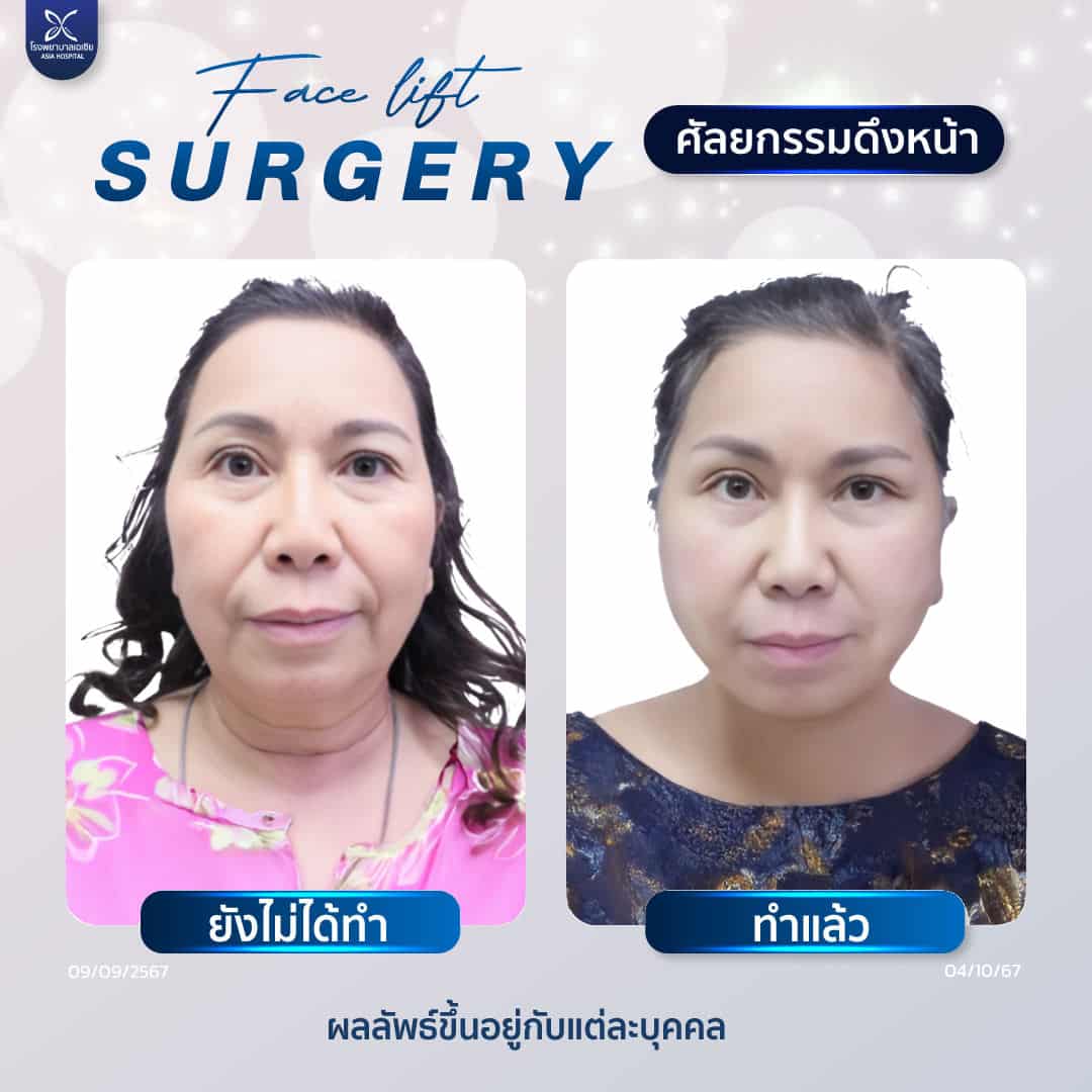 facelift_ดึงหน้า