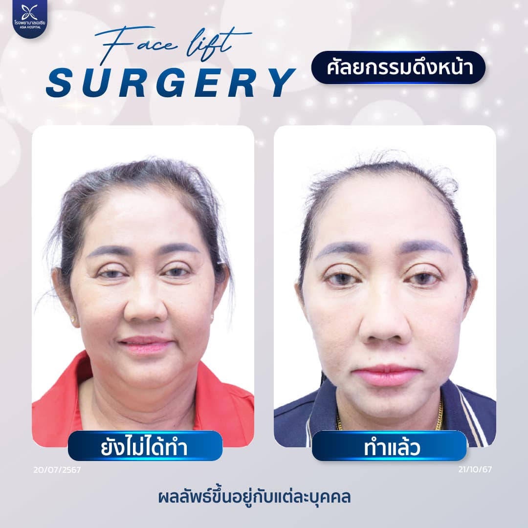 facelift_ศัลยกรรมดึงหน้า