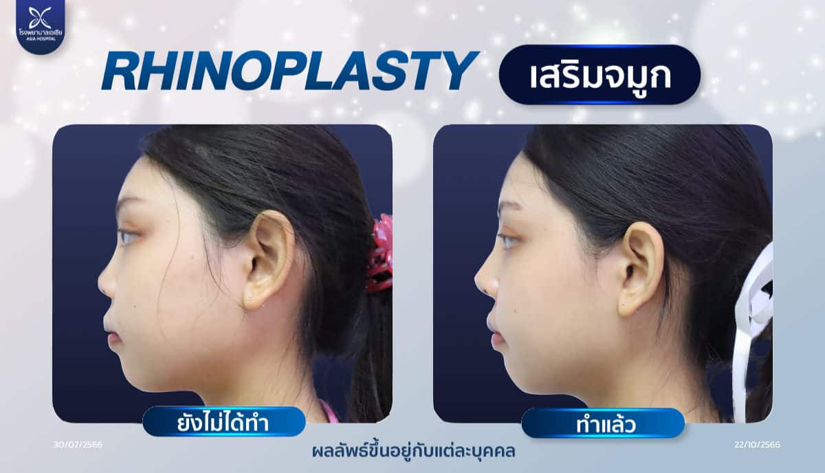 ศัลยกรรมเสริมจมูก