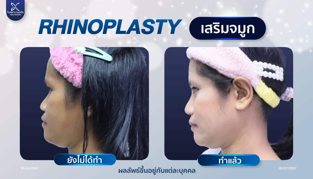 เสริมจมูก-rhinoplasty