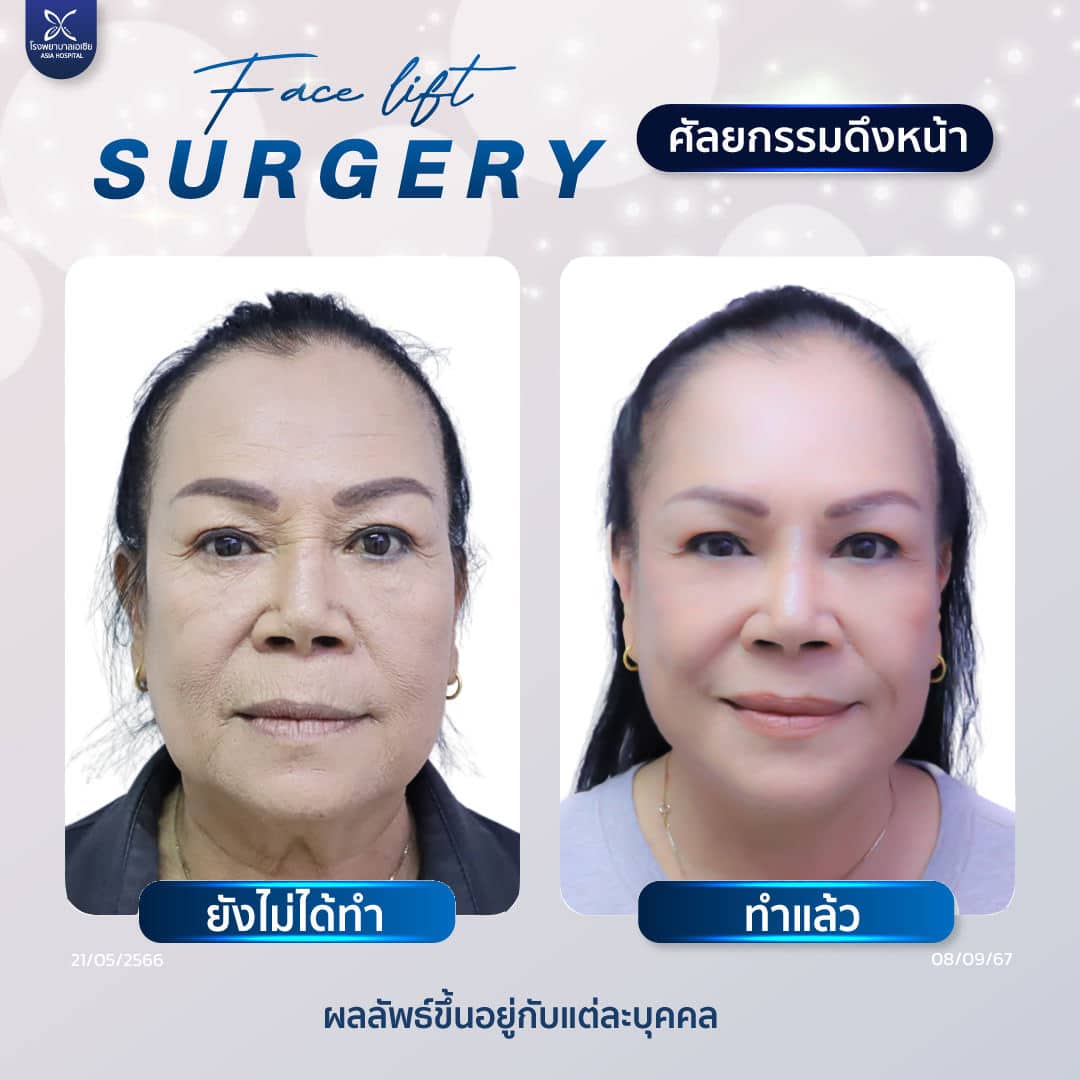 ดึงหน้า-facelift