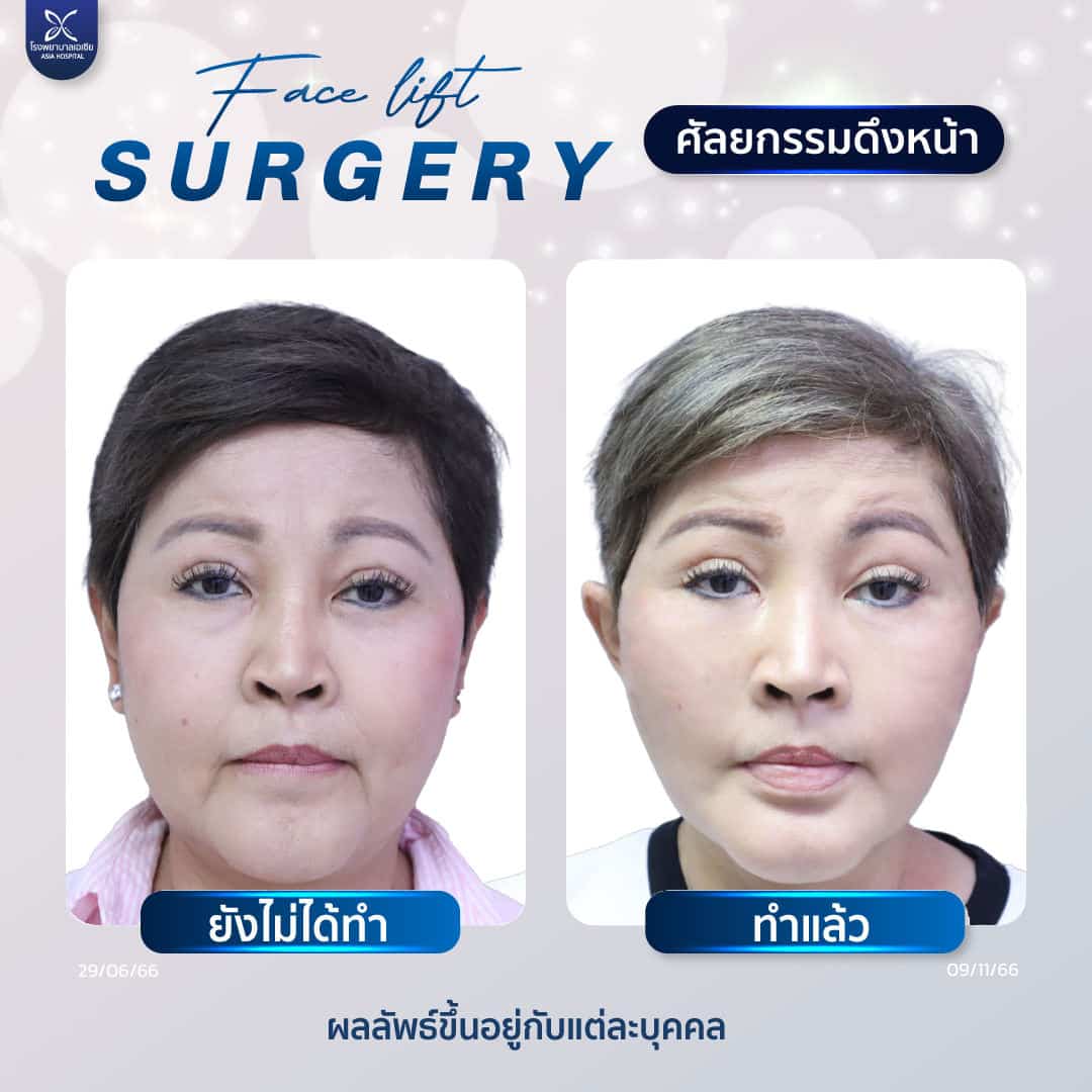 ดึงหน้า_ดึงคอ_facelift_necklift