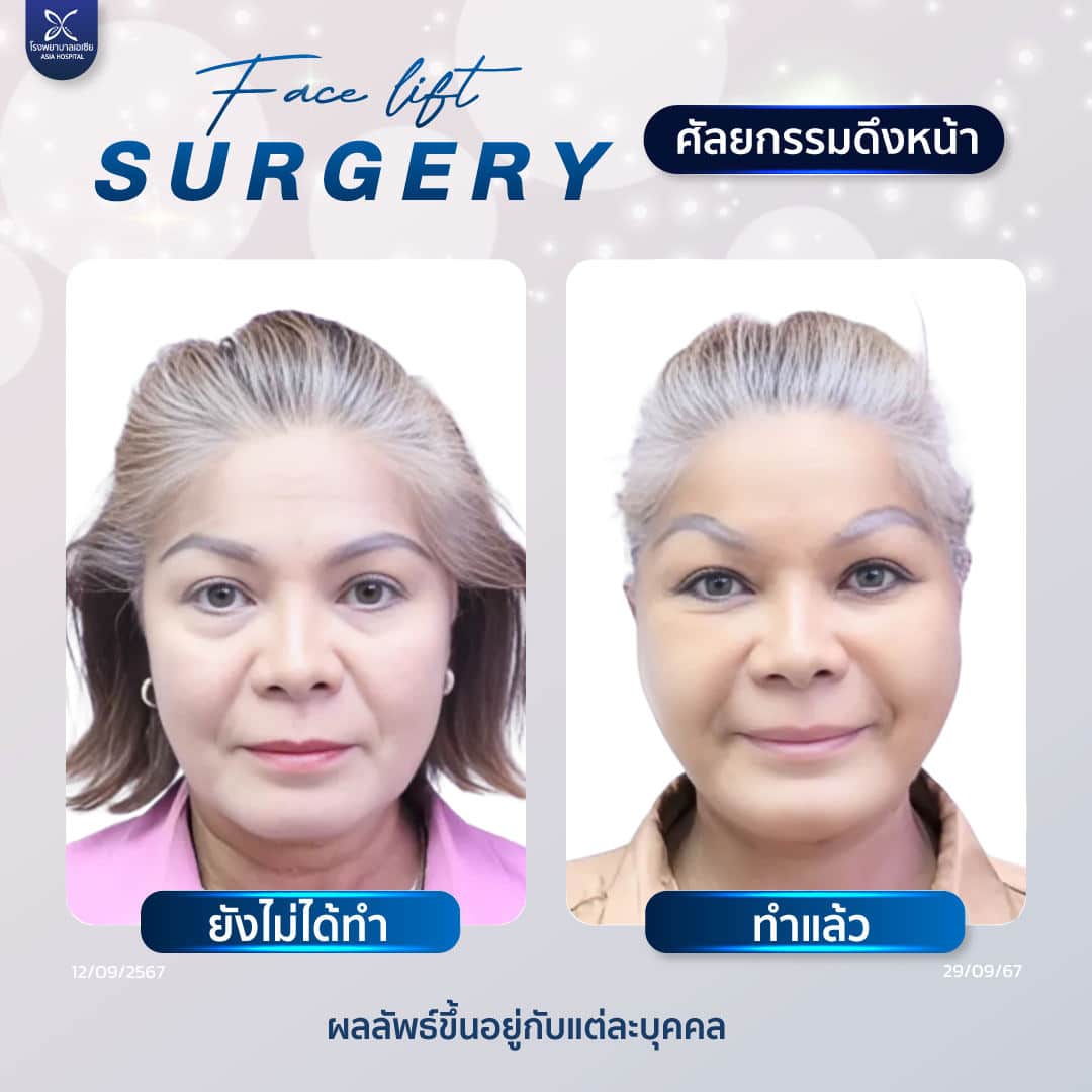 ผ่าตัดดึงหน้า_ยกกระชับ_facelift