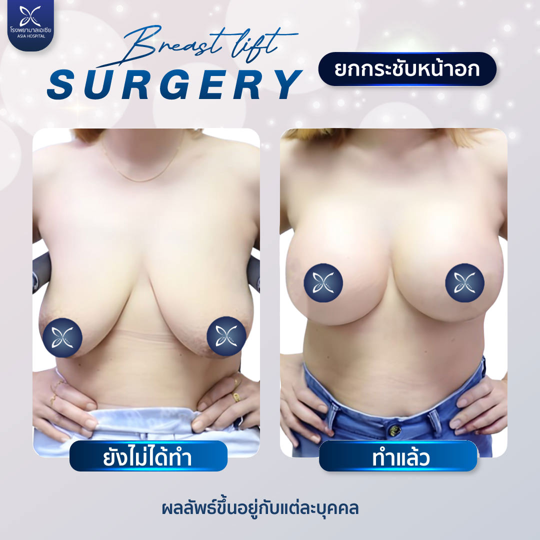 ยกกระชับทรวงอก