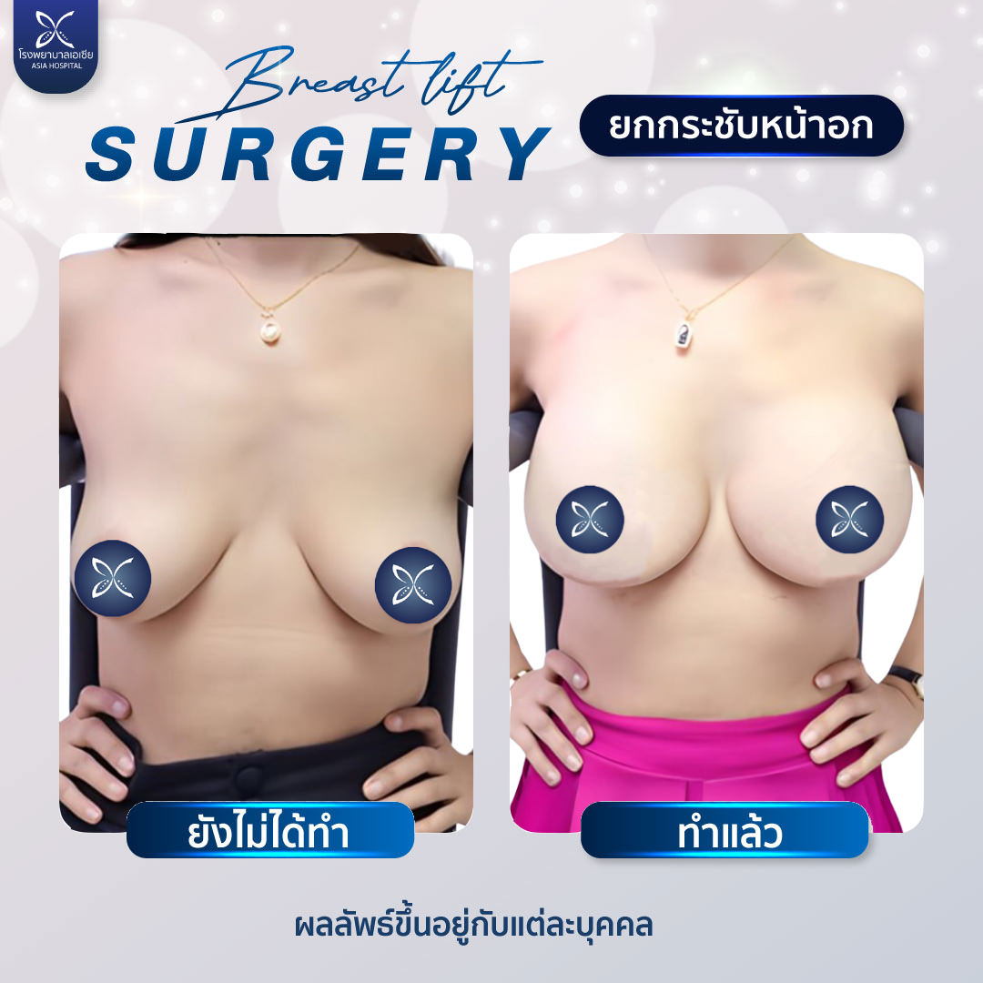 ยกกระชับหน้าอก Breast Lift Surgery