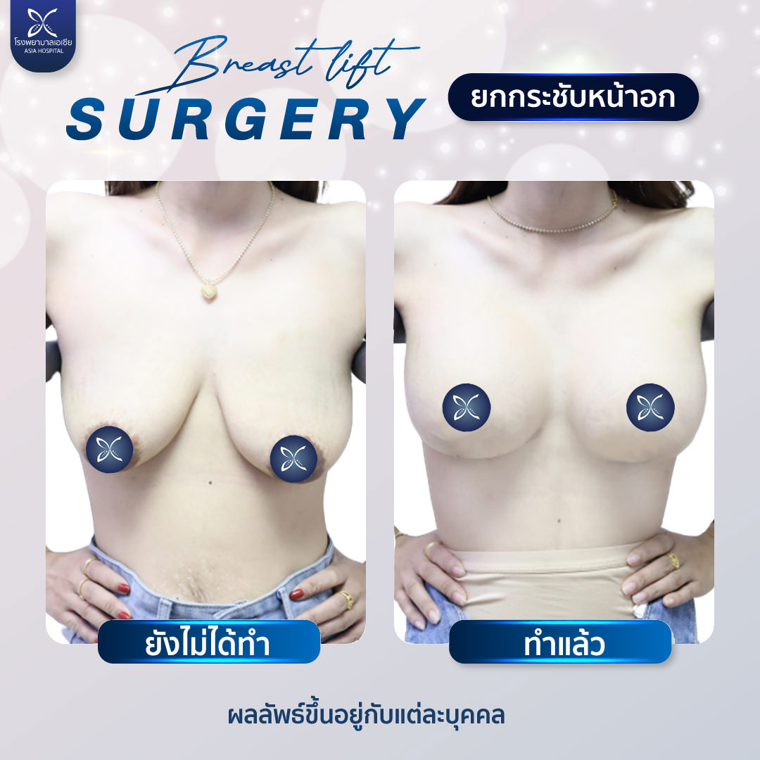 ยกกระชับหน้าอก Breast Lift