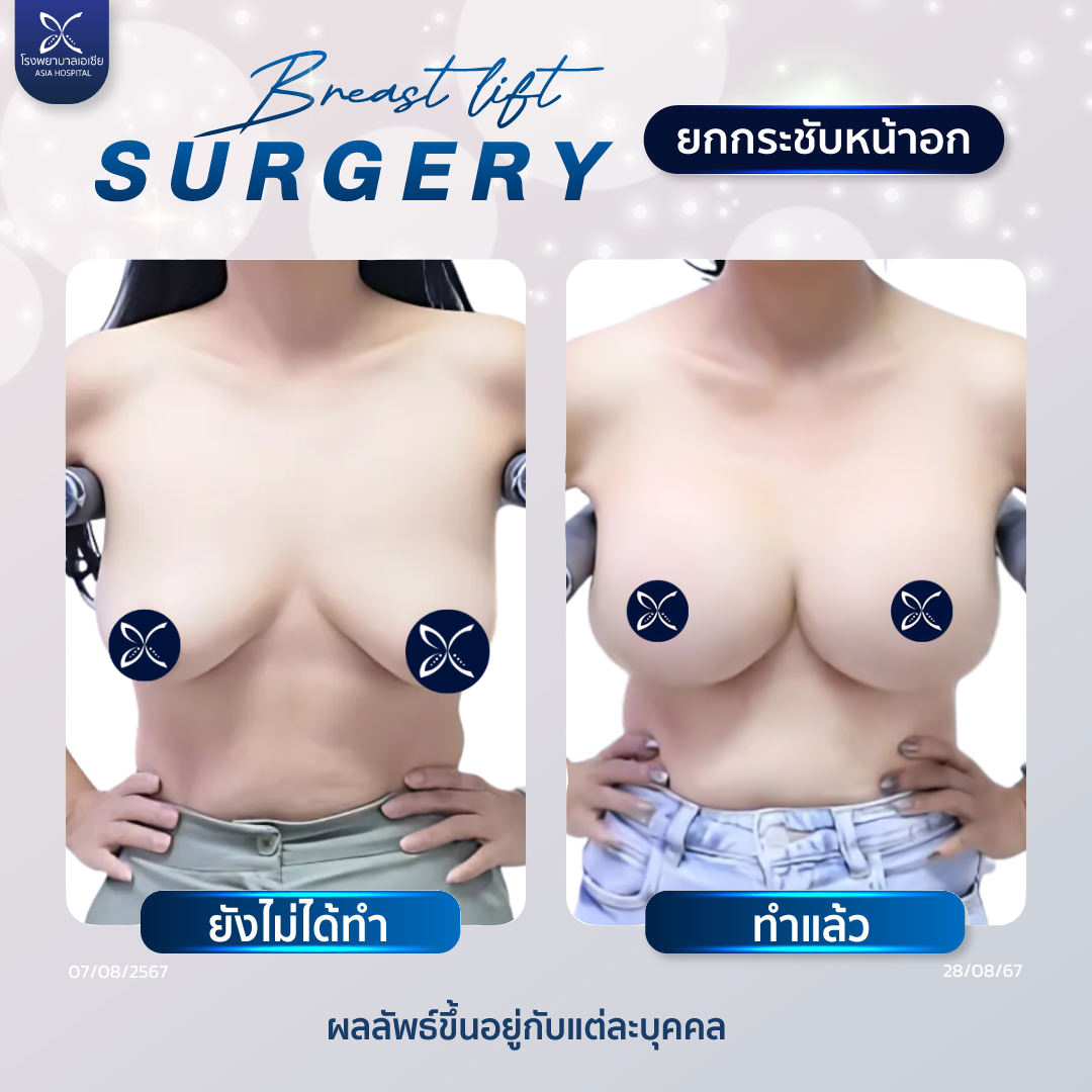 ยกกระชับหน้าอกราคา