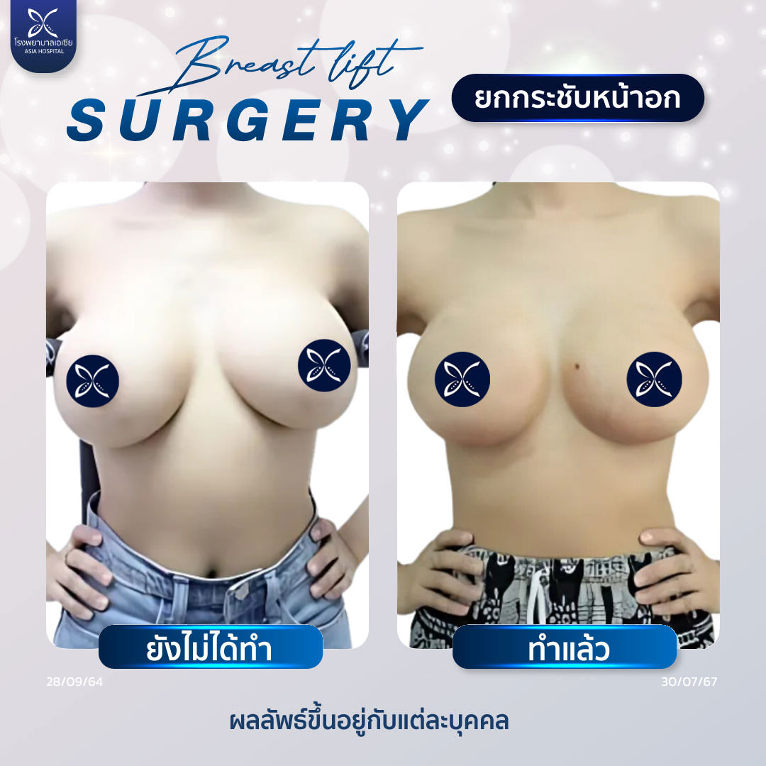 ยกกระชับหน้าอกรีวิว