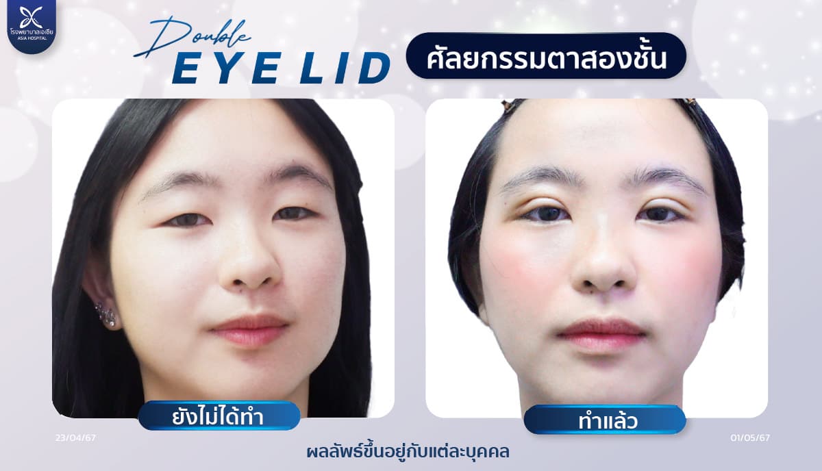 รีวิวทำตาสองชั้น