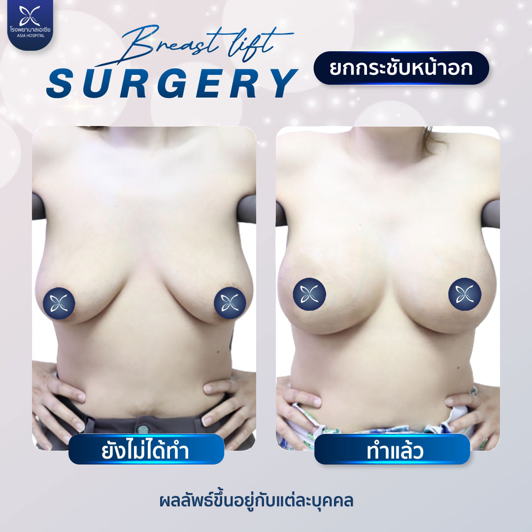 รีวิวยกกระชับหน้าอก