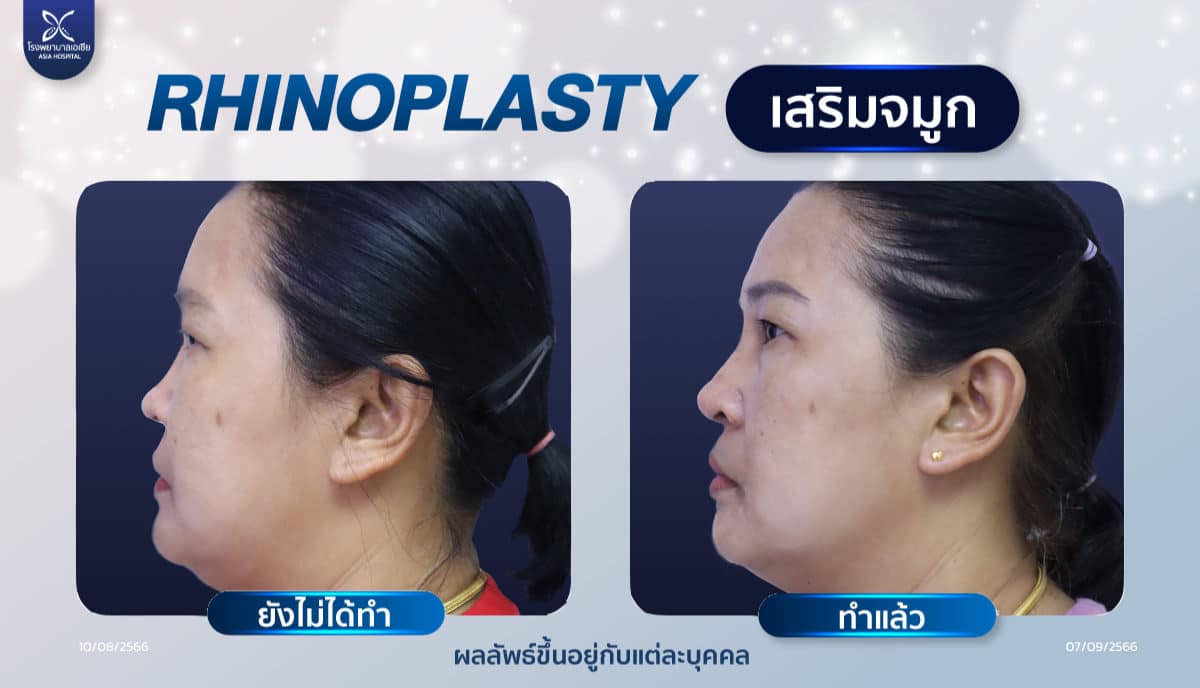 รีวิวเสริมจมูก-rhinoplasty