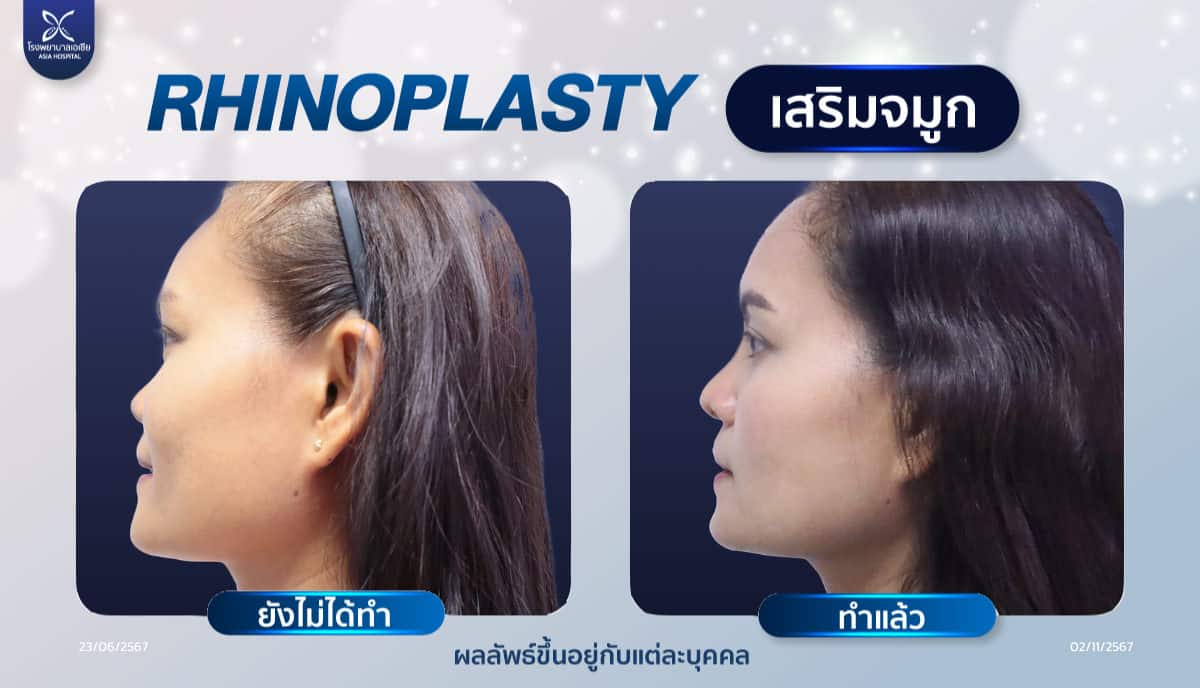 รีวิวเสริมจมูก