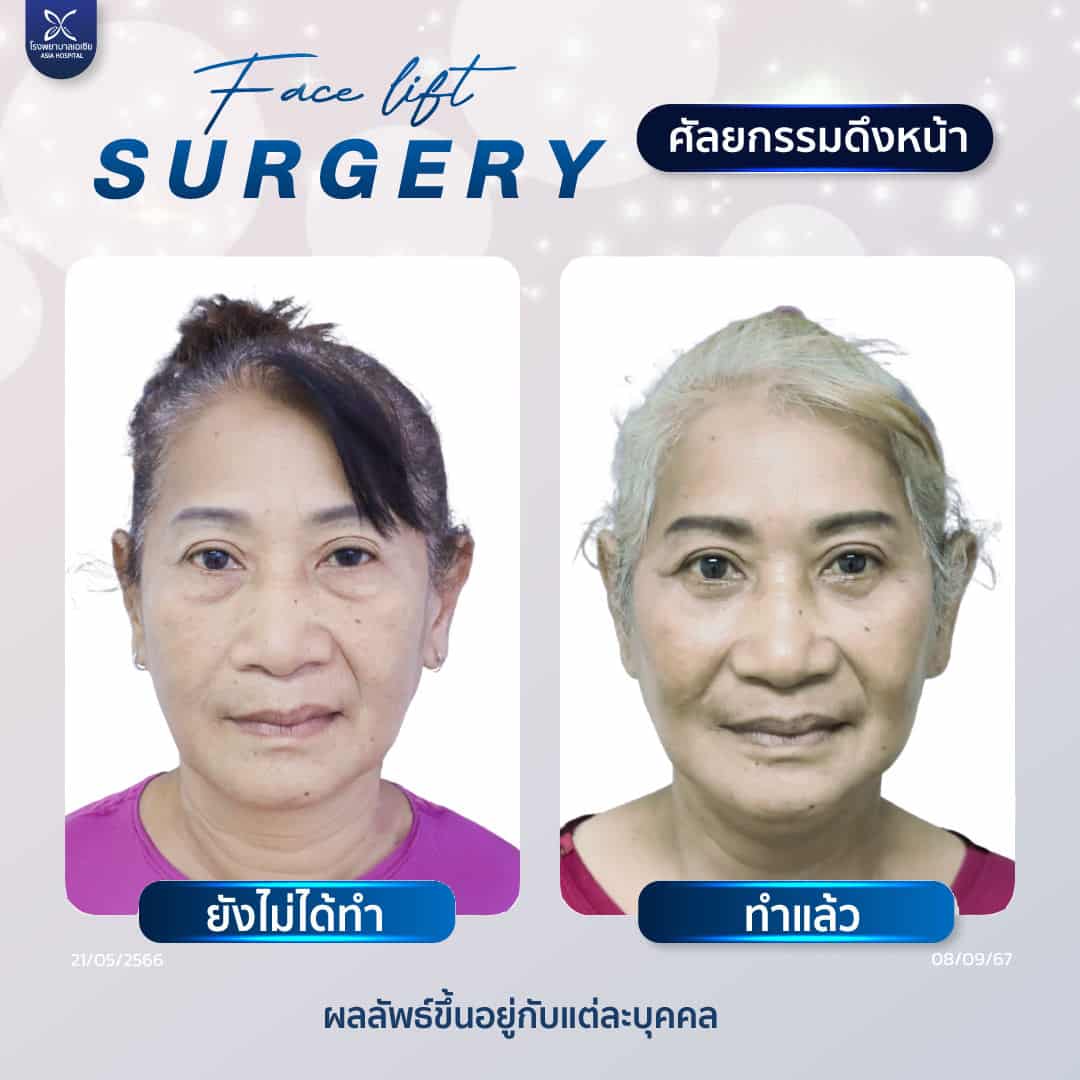 ศัลยกรรมดึงหน้า-facelift