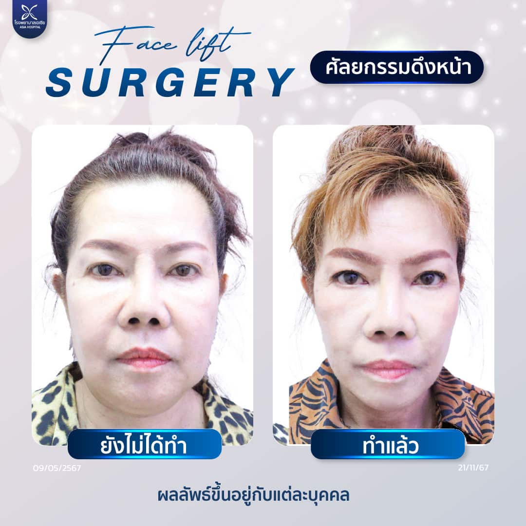 ศัลยกรรมดึงหน้า_facelift_surgery