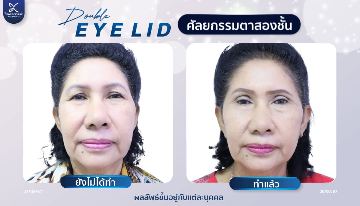 ศัลยกรรมตาสองชั้น