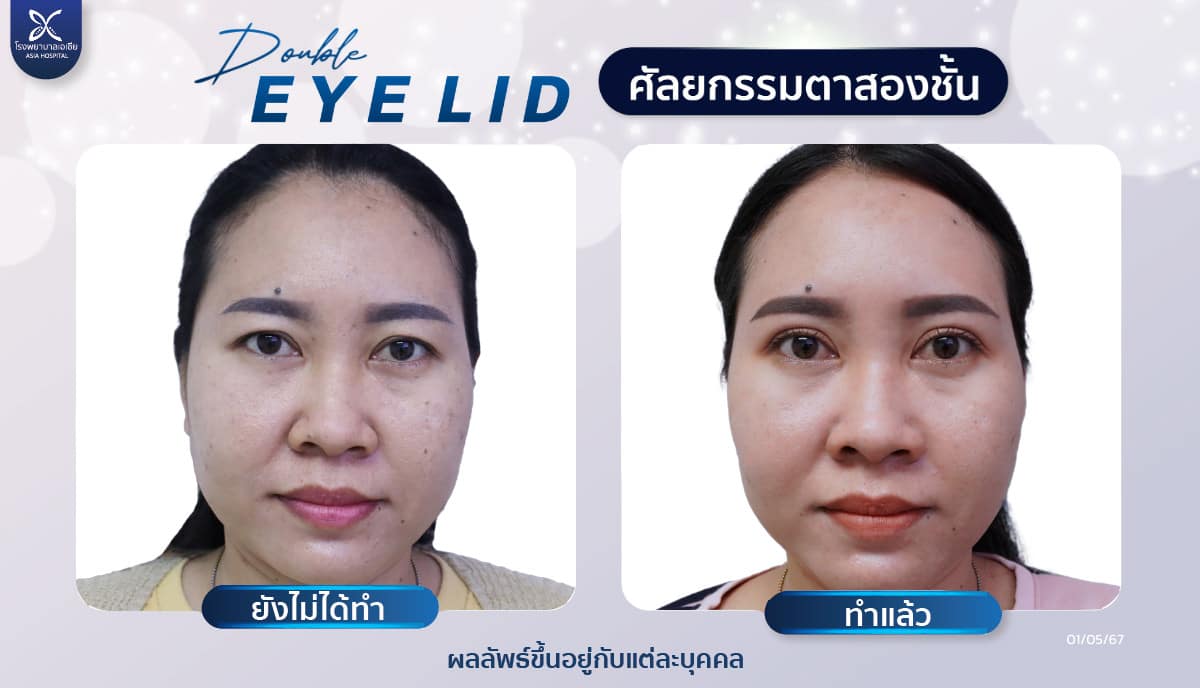ศัลยกรรมตาสองชั้น