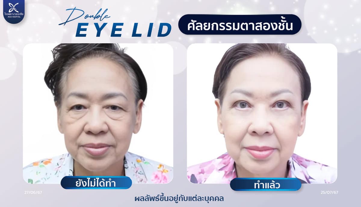 ศัลยกรรมตาสองชั้น