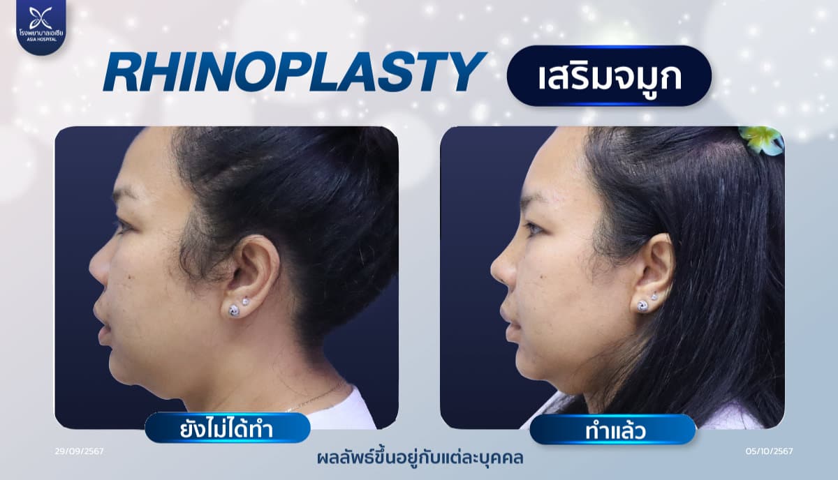 ศัลยกรรมเสริมจมูก
